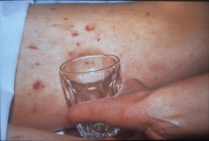 Meningitis Rash Glass Test