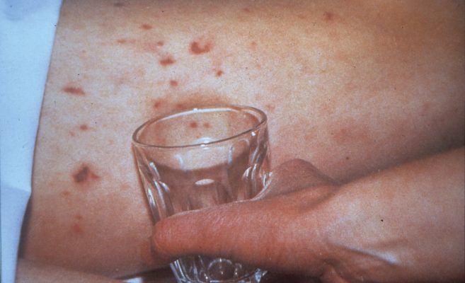 Meningitis Rash Glass Test